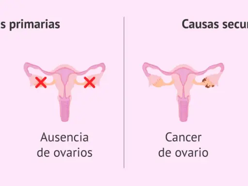 ¿Qué pasa si no te baja la regla en un mes? Causas primarias: retraso pubertad, ausencia ovarios. Causas secundarias: cáncer ovario, menopausia precoz.