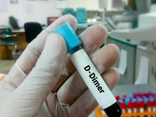 Rękawiczka trzyma probówkę z napisem "D-Dimer". W tle laboratorium, gdzie można dowiedzieć się, d-dimery jak obniżyć.