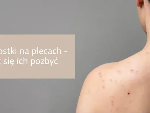 Pryszcze na plecach: Jak się ich pozbyć? Poradnik eksperta