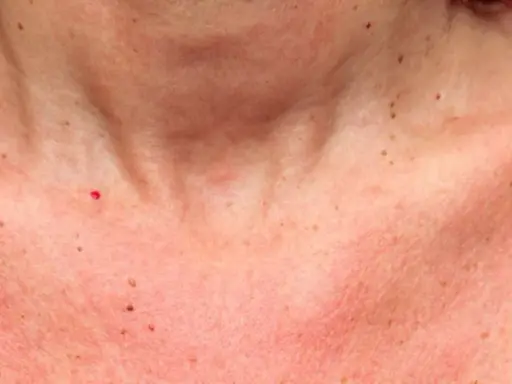 Peau rougie et irritée sur le cou et le décolleté, peut-être une réaction à une allergie au soleil. Combien de temps dure une allergie au soleil ?