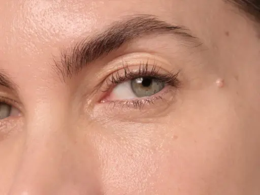 Gros plan sur un œil, montrant une peau claire avec une petite lésion sur la paupière, possiblement un signe de psoriasis paupière.
