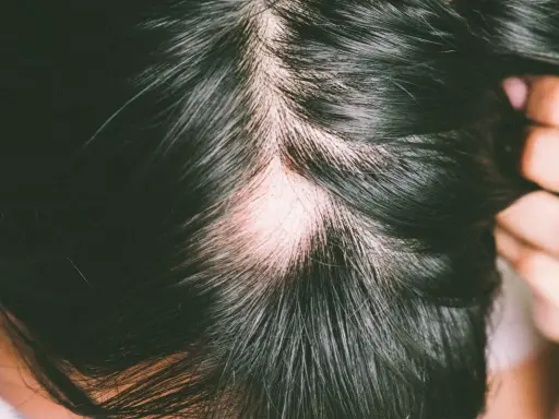 Plaque d'alopécie sur le cuir chevelu, révélant une peau pâle au milieu de cheveux foncés.