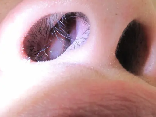 Primo piano delle narici, con peli visibili. Una speranza per chi soffre di polipi nasali: possono regredire.