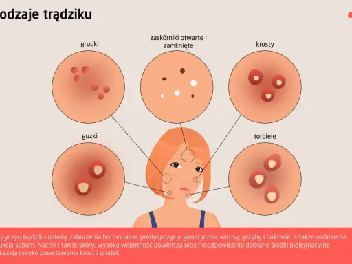Ilustracja pokazuje, jak wygląda trądzik: grudki, krosty, guzki, torbiele i zaskórniki.