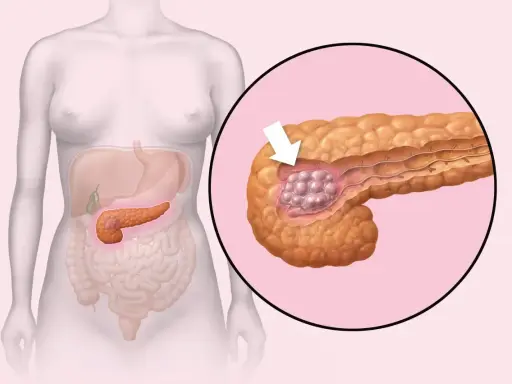 Ilustracja przedstawia trzustkę z guzem, wskazując na potencjalne przyczyny raka trzustki.