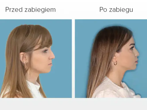 Przed i po zabiegu: poprawa wyglądu twarzy dzięki korekcie wady zgryzu.