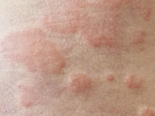 Czerwone, swędzące bąble na skórze. Czy pokrzywka jest zaraźliwa? Nie, to reakcja alergiczna, nie przenosi się przez kontakt.
