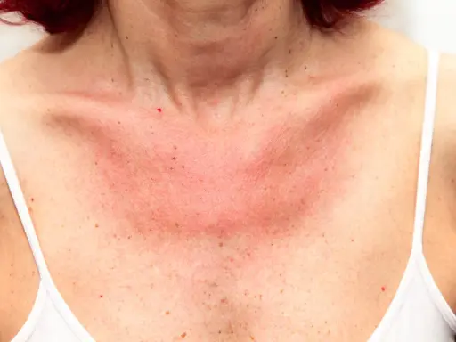Poitrine rouge et irritée, signe d'une allergie au soleil. Un remède grand-mère pourrait soulager cette peau sensible.