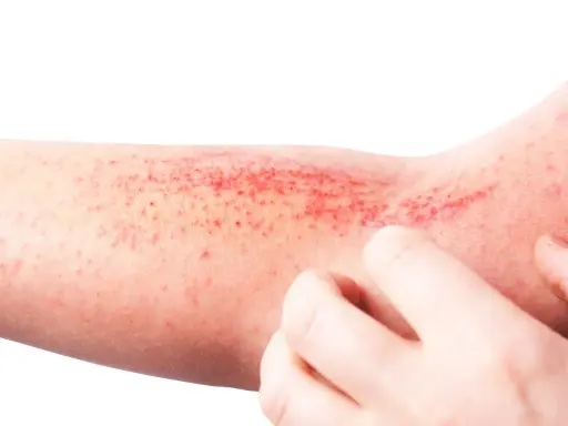 Braccio con eruzione cutanea rossa e pruriginosa, tipica della dermatite atopica. Le dita grattano la pelle irritata.