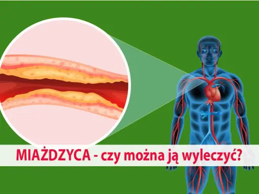 Ilustracja przedstawia ludzkie ciało z widocznym układem krążenia i powiększony przekrój tętnicy z miażdżycą. Jakie badania na miażdżycę są kluczowe?