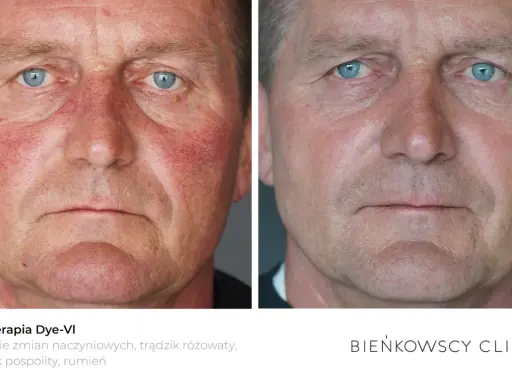Przed i po fototerapii Dye-VI. Zmniejszenie zaczerwienienia i wyprysków na twarzy po 50-tce.