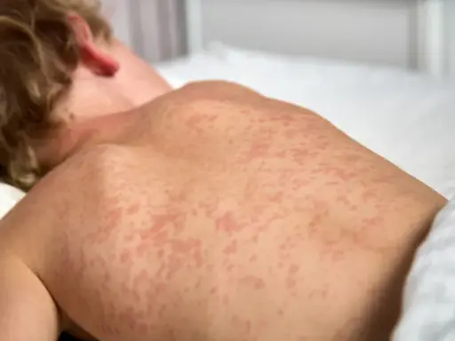 Sarpullido por medicamento: ¿Alergia? Síntomas y cuándo ir a urgencias.