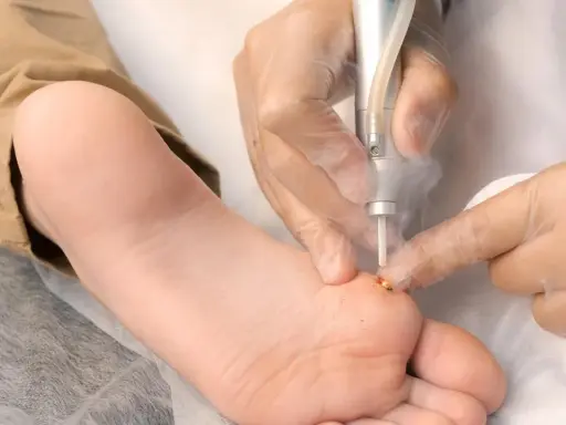 Traitement d'une verrue plantaire au laser par un podologue. Le tarif pour cette intervention est abordable.