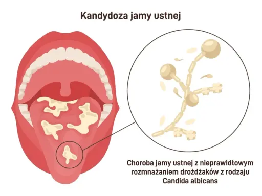 Kandydoza jamy ustnej: białe naloty na języku i podniebieniu, powiększone drożdżaki Candida. Czy kandydoza jest zaraźliwa?