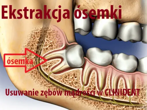 Ósemka na NFZ: Jak usunąć ząb mądrości? Przewodnik krok po kroku