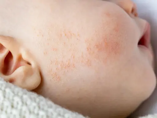 Gros plan sur la joue d'un bébé présentant des rougeurs et des petites plaques, signes d'eczéma bébé. La peau est irritée.