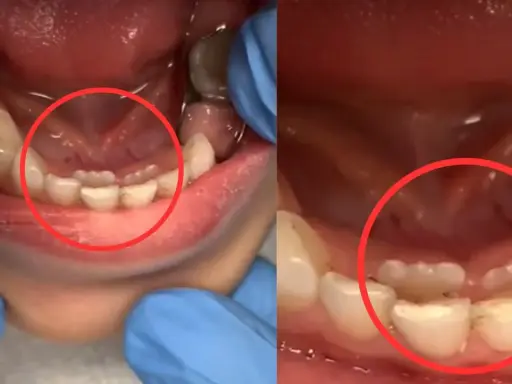 Dwa zbliżenia jamy ustnej dziecka, pokazujące ząbkowanie. Na lewym zdjęciu widać 6 zębów, na prawym 4. Ile zębów ma roczne dziecko?