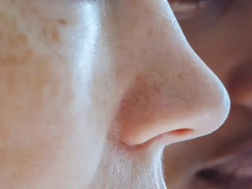 Gros plan sur un nez humain, montrant des pores dilatés et des filaments sébacés. Des taches de rousseur parsèment la peau.