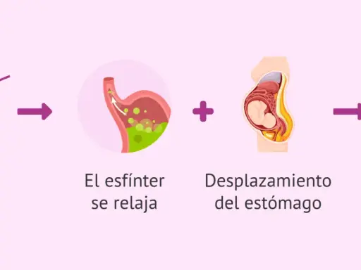 Aumento de progesterona y desplazamiento del estómago en el embarazo causan ardores estomacales.