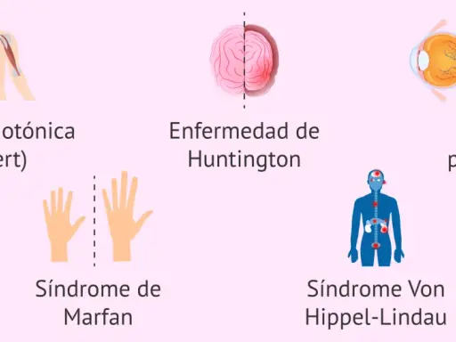 Ilustraciones de distrofia miotónica, Huntington, Marfan, Von Hippel-Lindau y retinosis pigmentaria, ejemplos de herencia autosomica dominante.