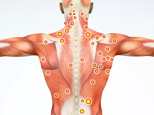 Muskulatur med markerade trapezius triggerpunkter. Röda cirklar med gula prickar visar var smärtan kan sitta.