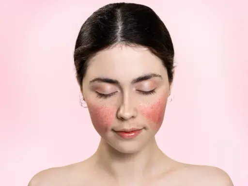 Visage d'une jeune femme aux joues marquées par une plaque rouge, les yeux fermés, sur fond rose doux.