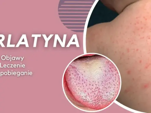 Szkarlatyna: czerwona wysypka na skórze i malinowy język. Objawy, leczenie i zapobieganie. Podobne do rumienia zakaźnego, ale wymaga innej diagnostyki.