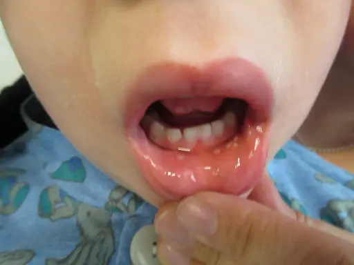 Barnets mun visar små blåsor och rodnad, tecken på herpetisk gingivostomatit.