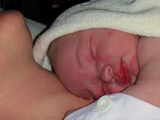 Nyfödd bebis med lite eksem på halsen, tätt intill mammas hud.