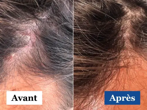 Comparaison avant/après d'un cuir chevelu atteint de psoriasis et dermite séborrhéique. La partie gauche montre des plaques rouges et squameuses, la droite une peau apaisée.
