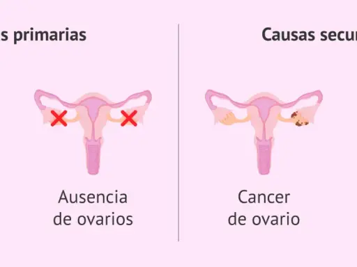 Ilustración explica que se puede tener la regla sin sangrar, mostrando causas primarias (retraso pubertad, ausencia ovarios) y secundarias (cáncer ovario, menopausia precoz).