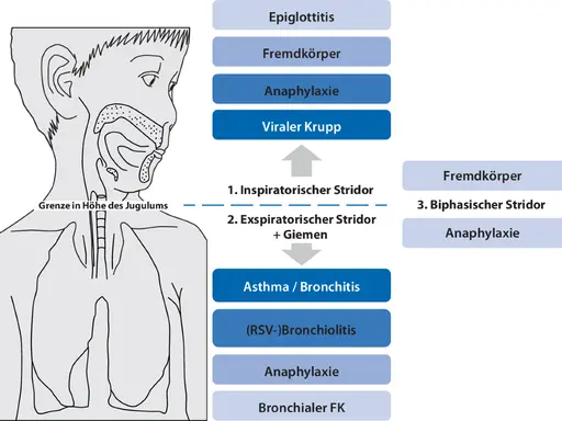 Schema zeigt Ursachen für Atemnot: Epiglottitis, Fremdkörper, Anaphylaxie, Krupp. Warum kriege ich schlecht Luft? Hier sind mögliche Gründe.