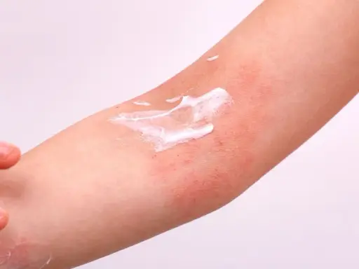 Application de crème sur une plaque sèche et rouge sur le bras, soulageant l'irritation cutanée.