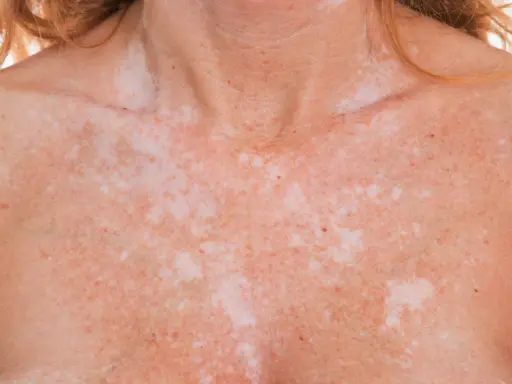 Poitrine et cou d'une personne présentant une dépigmentation de la peau, avec des taches claires et foncées.