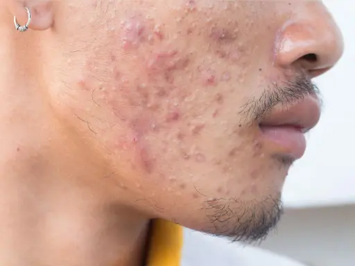 Gros plan sur le visage d'un homme présentant une acné sévère, avec des rougeurs et des pustules visibles sur la joue et le menton.
