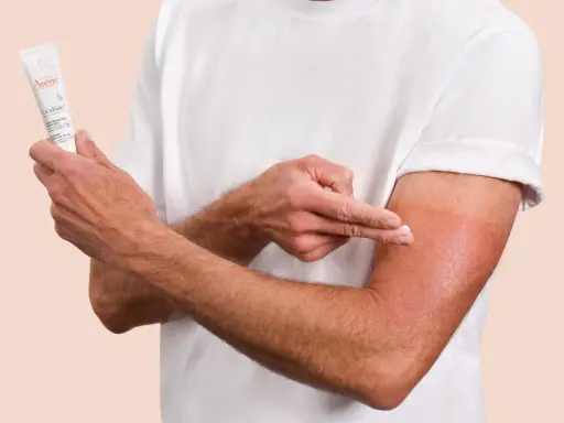 Un homme applique la crème Cicalfate+ sur son bras irrité, peut-être atteint de psoriasis, pour apaiser et réparer sa peau.