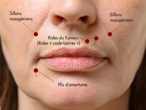 Gros plan sur le bas du visage d'une femme, montrant les sillons nasogéniens, les rides du fumeur et les plis d'amertume.