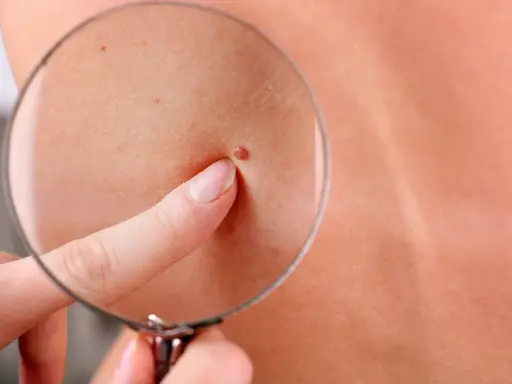 Un doigt pointe un grain de beauté qui saigne, observé à travers une loupe sur une peau claire.