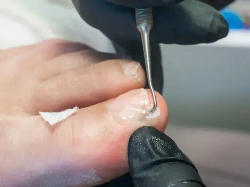 Prise en charge podologue diabète : un professionnel utilise un instrument pour nettoyer délicatement un ongle de pied, assurant des soins essentiels.