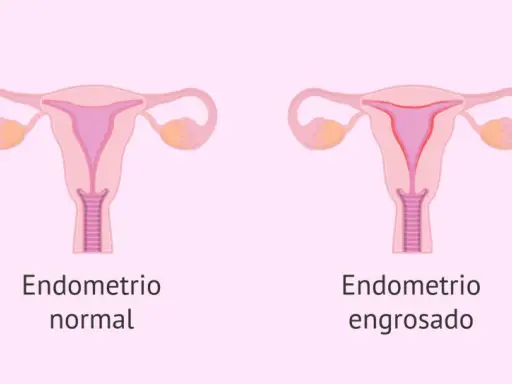 Comparación visual de un útero con endometrio normal y otro con endometrio engrosado, indicativo de hiperplasia endometrial.
