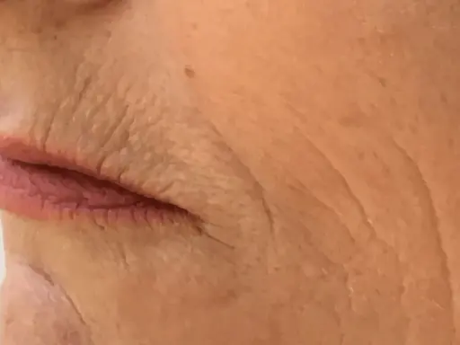 Nahaufnahme der Lippen und der Haut einer älteren Person mit tiefen Falten, die auf die Auswirkungen des Rauchens hinweisen. Kleine Pickel sind sichtbar.