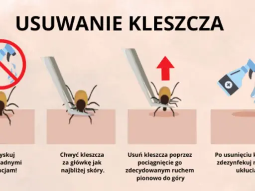 Kleszcz: Wyciągnij, nie wykręcaj! Prawidłowa instrukcja krok po kroku