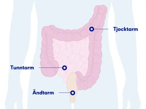 Illustration av tunntarm, tjocktarm och ändtarm. Kan ge en känsla av svullen mage och illamående.
