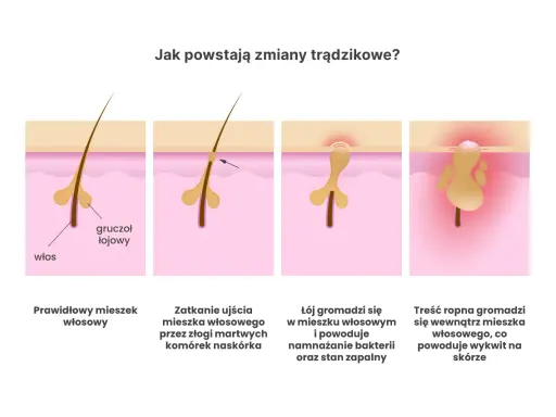 Ilustracja pokazuje powstawanie zmian trądzikowych: zatkanie mieszka włosowego, namnażanie bakterii i stan zapalny. Domowe sposoby na trądzik młodzieńczy mogą pomóc.