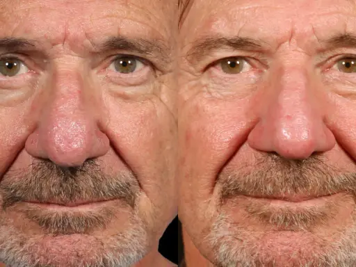 Gros plan sur le visage d'un homme, montrant les effets de la rosacée phymateuse sur son nez et ses joues.
