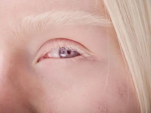 Blond włosy i jasne brwi otaczają fioletowe oczy, świadczące o albinizmie.