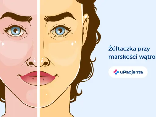 Żółtaczka przy marskości wątroby, jeden z objawów alkoholowego zapalenia wątroby, powoduje zażółcenie skóry.