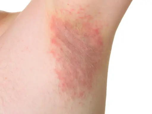 Irritazione cutanea sotto le ascelle, con chiazze rosse e sensazione di prurito sotto le ascelle senza rossore visibile.