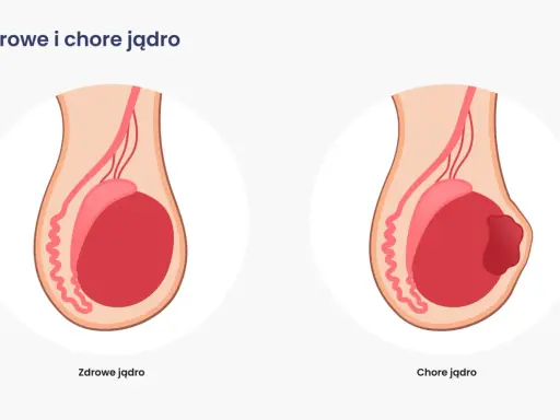 Ilustracja porównuje zdrowe jądro z chorym, na którym widoczny jest guz, wskazujący na raka moszny.