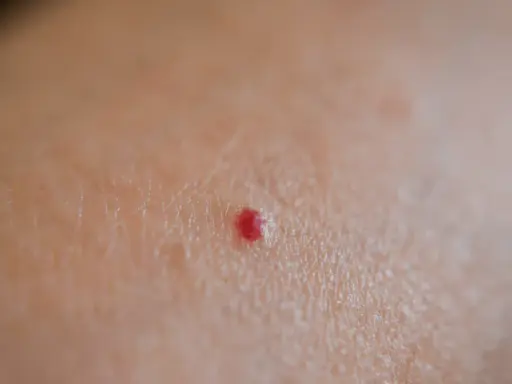 Una piccola macchia rossa sulla pelle, un neo rubino, senza alcun prurito.